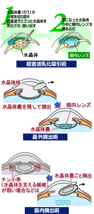 超音波乳化吸引術・嚢外摘出術・嚢内摘出術