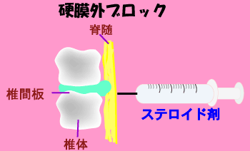 硬膜外ブロック