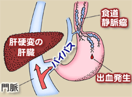 肝硬変