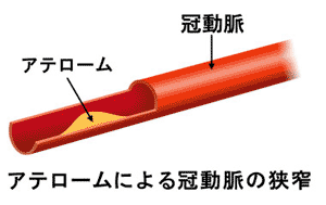 アテロームによる冠動脈の狭窄