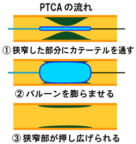 PTCA