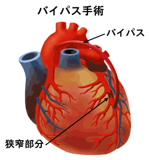 バイパス手術