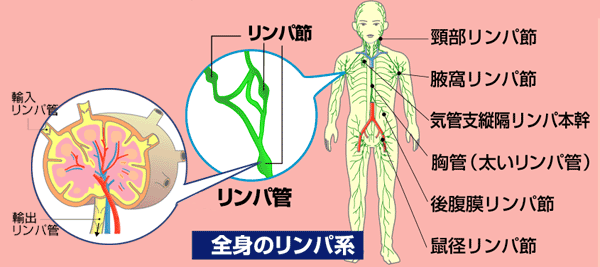 悪性リンパ腫 病気の知識 介護の知識 訪問看護 24時間の在宅看護等のサービスを自費で ナースアテンダント