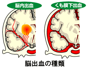 脳出血の種類