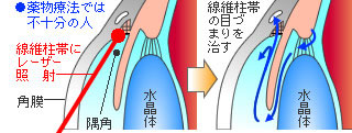 緑内障の治療