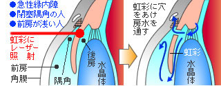 レーザー虹彩切開術