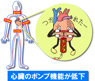 心臓のポンプ機能が低下