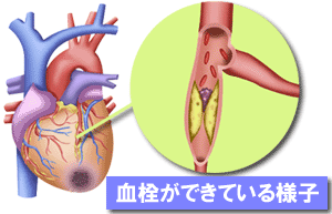 血栓ができている様子