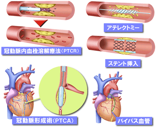 心筋梗塞の治療法