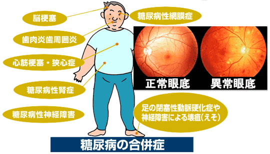 糖尿病の合併症