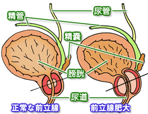 前立腺肥大